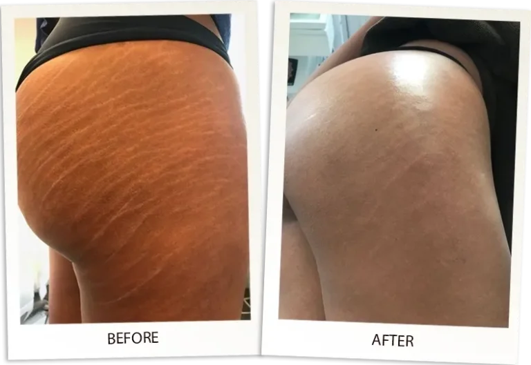 Carboxy Therapy
