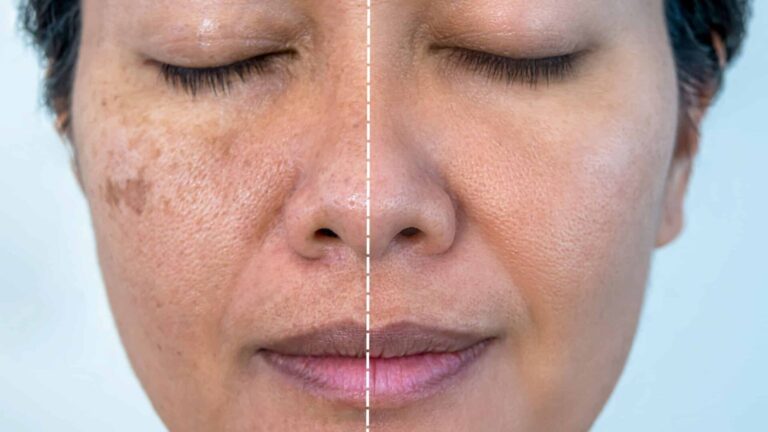 Chemical Peel