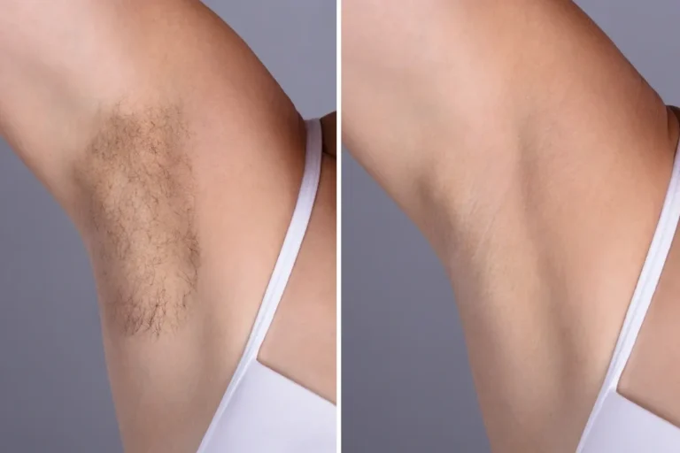 IPL Laser Hair Removal