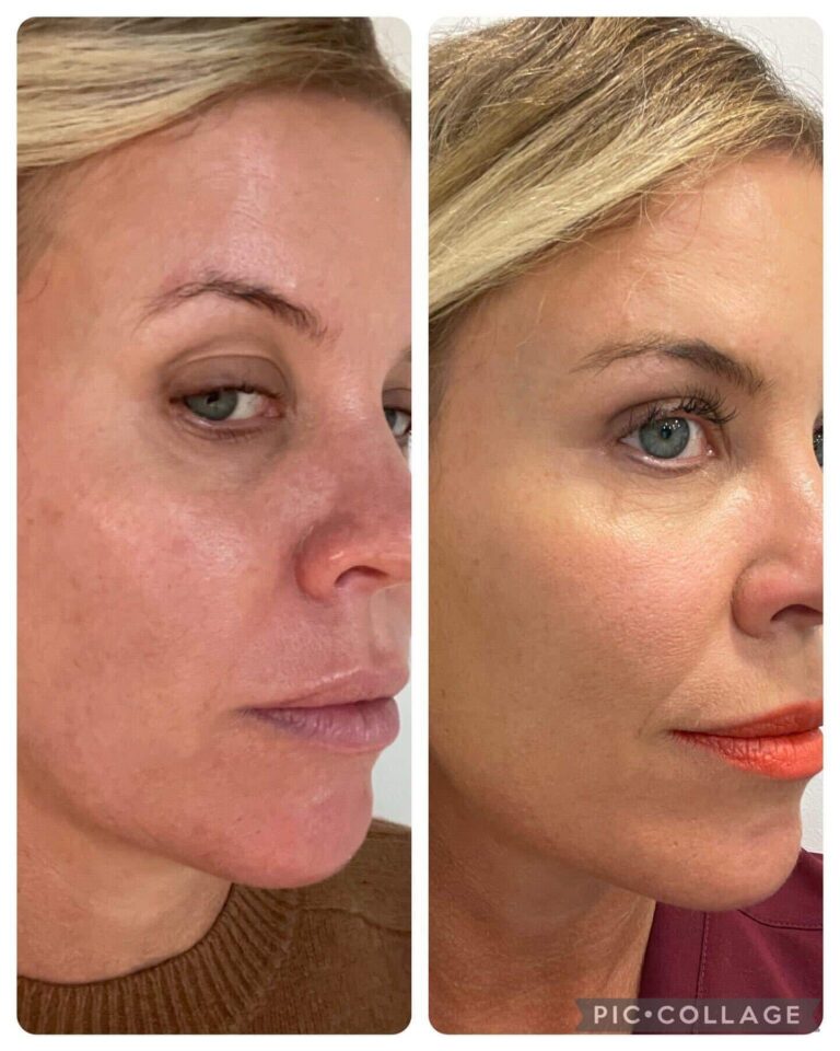 Prophilo Skin Booster