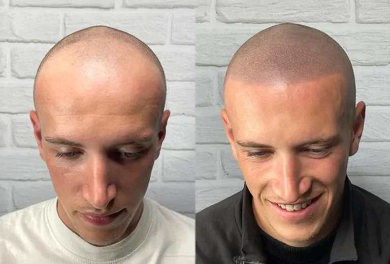 Scalp Micropigmentation