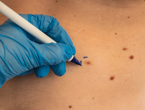 Skin Tag Removal