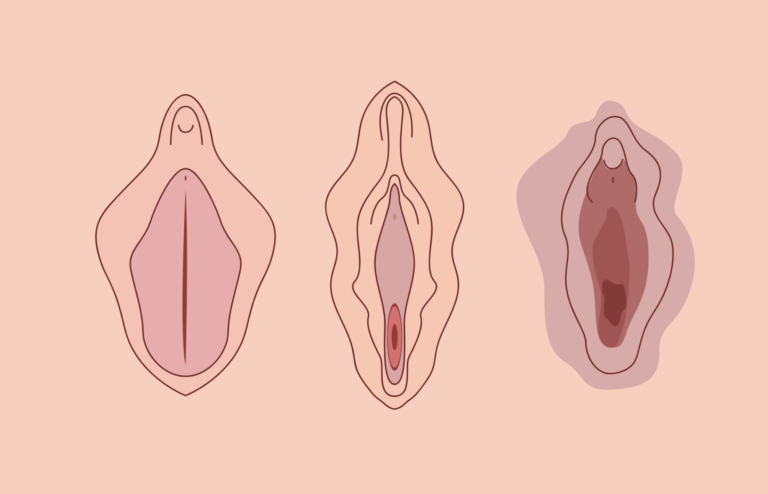 Vaginal HIFU