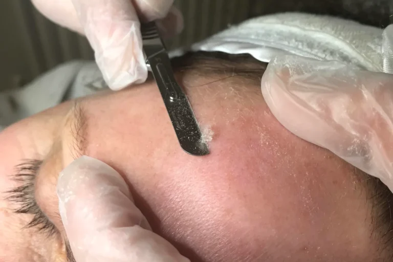 Dermaplaning