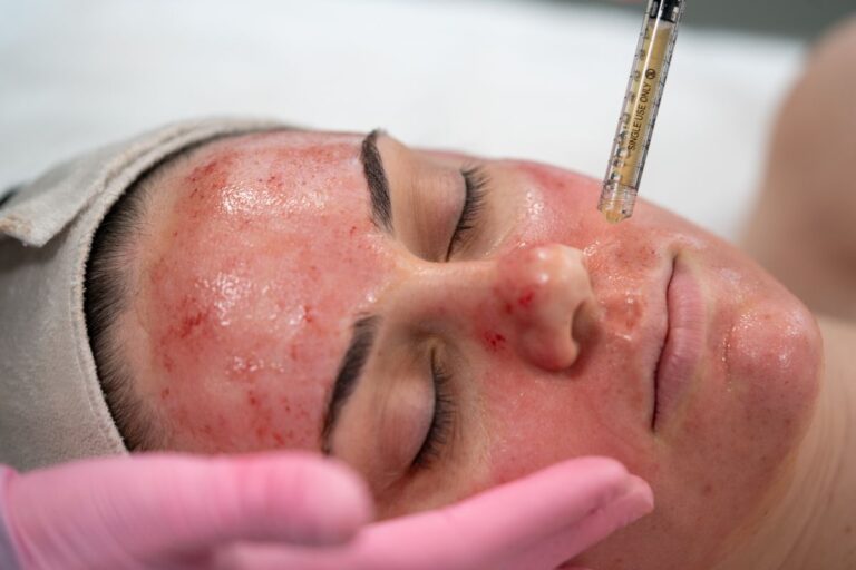 Vampire Facial